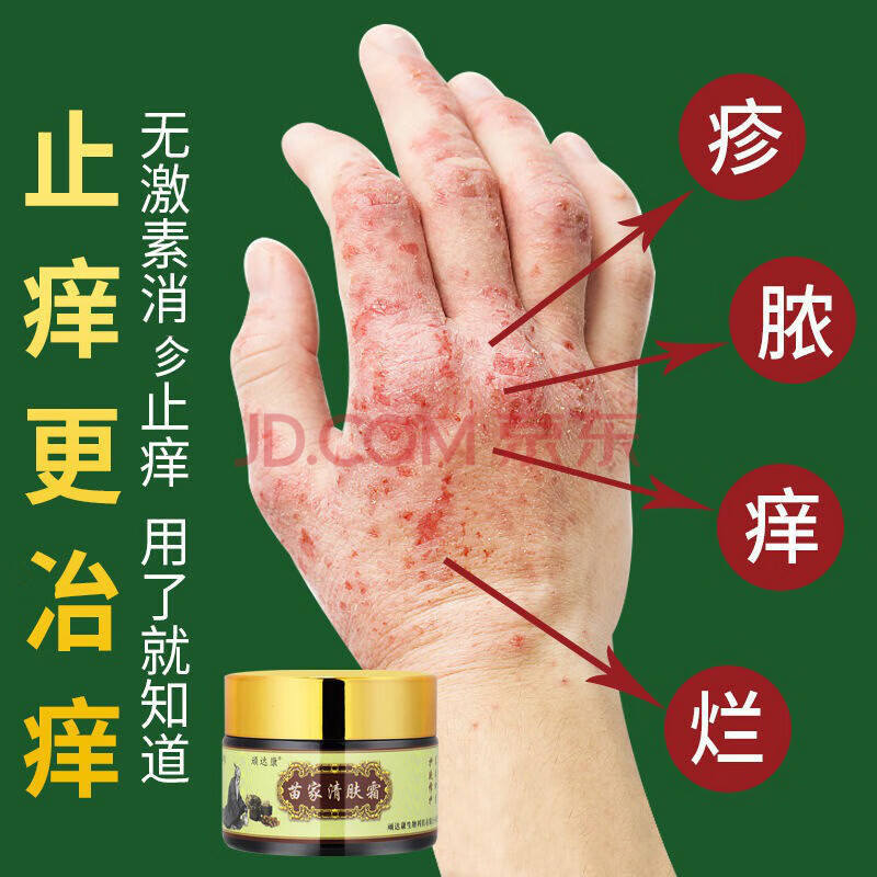 断痒皮肤外用抑菌乳膏成人外用皮肤止痒膏软膏湿痒独疹乳膏草本乳膏