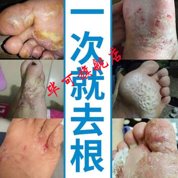 脚痒脱皮丫脚臭喷剂脚趾缝开裂止痒膏除水泡喷剂 买三实发5盒