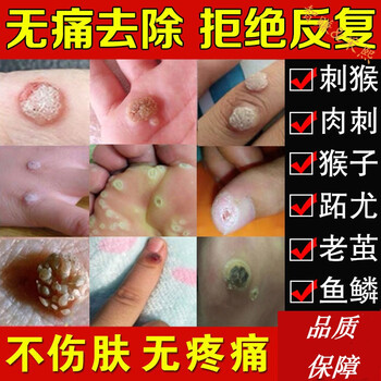去i除扁平尤手部疣瘊灵去i鸡茧i膏i贴去i刺猴跖尤买二赠一