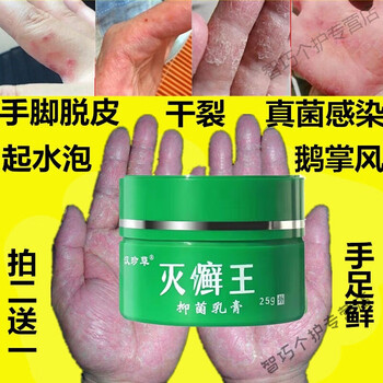 手xx癣皮l炎湿l疹皮肤瘙痒止痒手足xx癣真菌感染汗h疱p疹水泡手痒脱皮