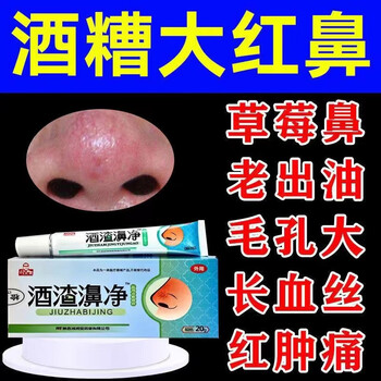酒糟鼻软膏红鼻头红血丝草莓鼻子粗糙发红酒渣濞净鼻螨清红鼻子膏 三
