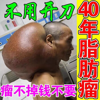 脂肪瘤去除神器不手术专消48种皮下脂肪瘤硬快囊肿专用喷剂单盒装轻度