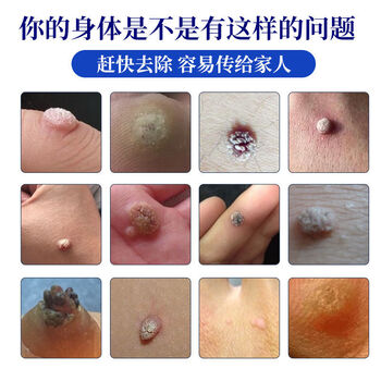 祛痣无痕膏不留疤无痕无痛去痣克疣膏脸部除黑痣去疣膏点痣膏祛痣粒