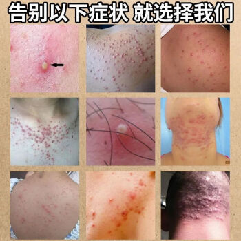 阴部毛囊焱外阴疙瘩脓包肛门瘙痒肛周湿l疹大腿内侧湿痒膏止l痒特孝买