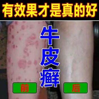 顽固牛皮x癣日本技术银i屑病偏方头皮x癣体x癣手足i癣湿x疹皮x炎1盒