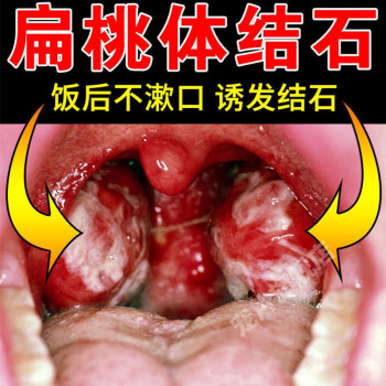 【吐出結石】扁桃體結石貼喉結石咽喉異物感腫痛口臭咽l炎吞嚥困難 1