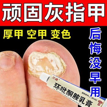 环吡酮胺乳膏万通 治灰指甲药膏 指甲真菌感染灰甲发黄变空变厚坏甲癣