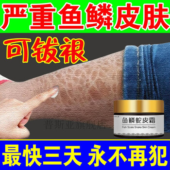 鱼鳞皮肤霜可拔垠大小腿部鳞屑干燥纹路病蛇皮肤身体乳全身1盒体验装