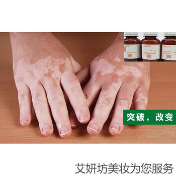 白之选复方补骨脂酊外用促黑色素生成白癜净修复液消白宁50ml1瓶