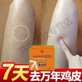 皮肤有鸡皮疙瘩用什么药膏(皮肤起鸡皮疙瘩用什么药可以擦)