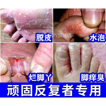 官方旗艦腳上長癢水泡腳上長小水泡癢腳丫上腳底起水泡癢水泡脫皮爛i