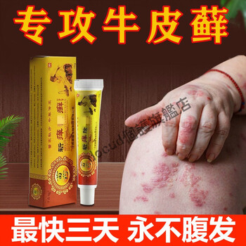 荨l麻l疹头皮x癣体x癣皮肤瘙痒皮p炎止痒膏 15g一支装