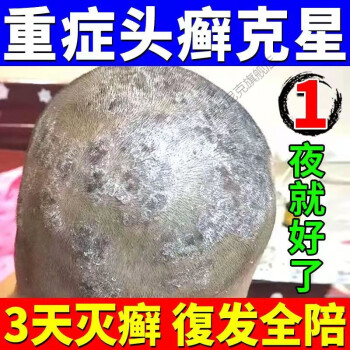 沐浴露牛皮1癬專冶皮1癬銀1屑病鱗屑止癢手足1癬體1癬紅1斑起皮一盒