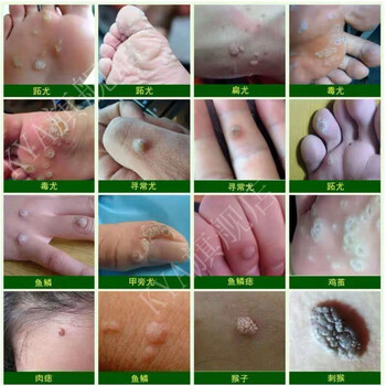【旗舰优选】南同搭软膏去尖锐湿疣hpv面部粒刺猴脖子瘊 械字号用品非