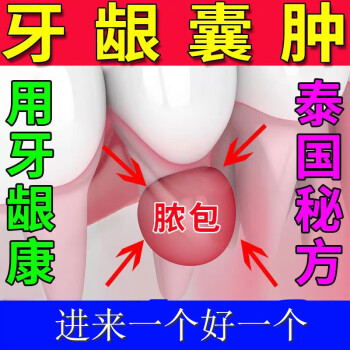 牙齦囊腫101解決牙齦腫脹長包牙齦炎牙周l炎疼痛快速修復噴劑1盒輕微