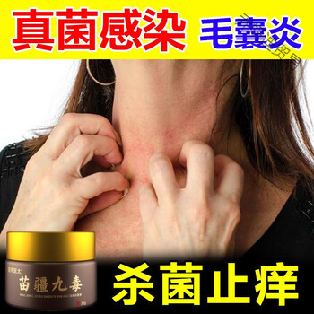 马拉色菌毛囊炎膏真菌克星去除脸部背部骚痒红肿脓包买三加二发五盒