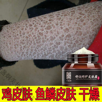 腿干到起皮抹身体乳(腿上起皮屑用什么身体乳)