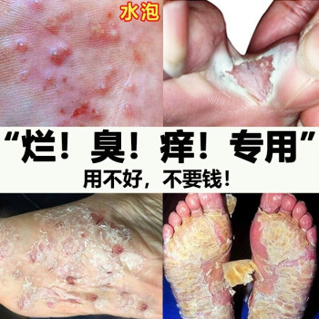 老賴鈹腳氣噴劑腳臭噴霧星克去治薬腳氣根除治腳癢脫皮爛糜腳丫水泡型