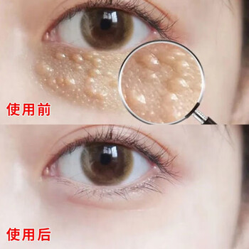 【专攻脂肪粒去除】南方协和草本眼部精华 去汗管瘤眼霜油脂粒祛除