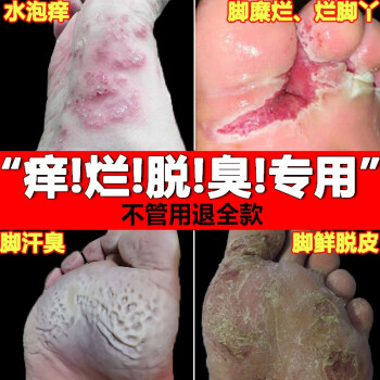 去治根脚气喷剂脚痒脱皮脚臭喷雾除汗脚上长痒水泡脚型烂香脚丫脚趾缝