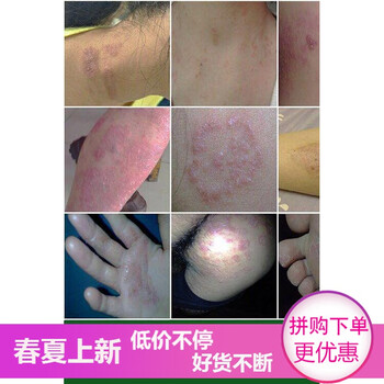 头癣膏治疗头皮癣专用软膏外用治头癣的药膏去头癣头痒银屑癣头藓
