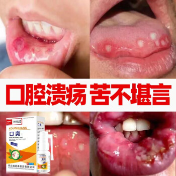 口腔潰瘍化噴劑牙齦腫痛複發性口瘡口舌生瘡非咽l炎起泡上火起泡爛