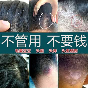 毛囊炎洗发水毛炎宁洗发液去屑止痒控油洗发露头皮痘痘脓包抗真菌脂溢
