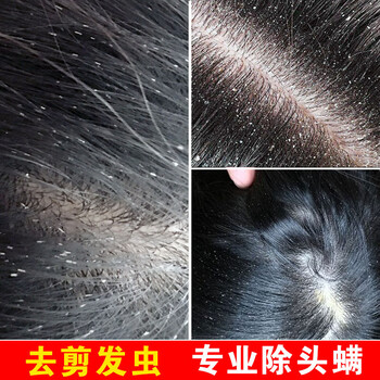 去卷发虫除吃发虫儿童去屑止痒断发抗真菌除螨虫剪发虫洗发水110ml一