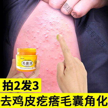 怎么能简单去鸡皮疙瘩(怎么能简单去鸡皮疙瘩呢)