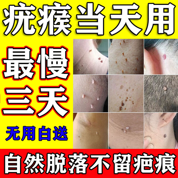 ESTENY扁平疣专用非药疣瘊灵脖子上长的小肉粒疙瘩猴子去非除非药乳膏 1盒装脖子上长肉粒小疙瘩【图片 价格 品牌 报价】-京东
