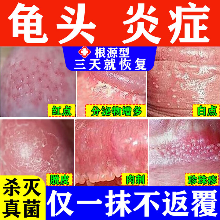 龟头红点瘙痒霉菌性龟头炎专用膏药龟头真菌感染红肿性病专用药阴茎男人私处瘙痒男科皮肤用药硝酸咪康唑乳膏 3盒【严重龟头小红点 白垢 脱皮刺痛】一 ...