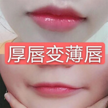 【香肠嘴没了】厚嘴唇变薄嘴唇薄唇精油香肠嘴厚唇改薄女生男生通用大嘴巴缩小嘴巴淡化唇色唇纹 【买二送一 厚唇变薄】