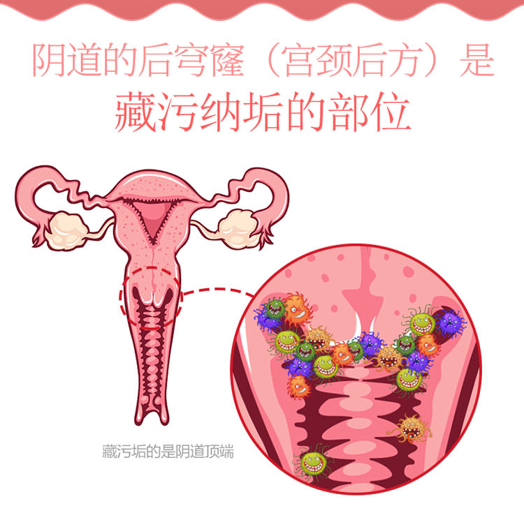 医用阴道冲洗器妇科清洗器内阴到妇洗器家用女性洗阴器私处无菌可重复